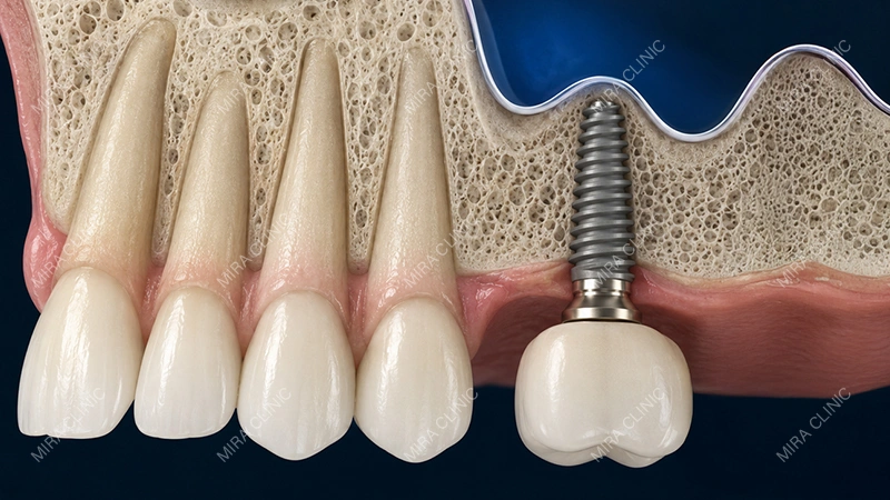 Sinus Affect Dental Implant Placement